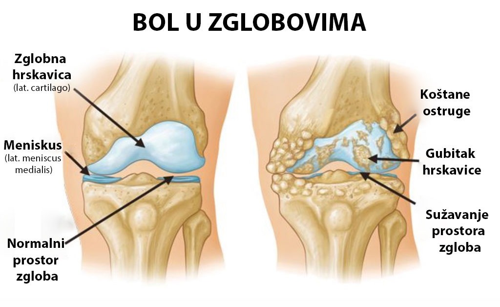 artroza koljena liječenje cijena bolove u zglobovima u stopalu nego liječiti
